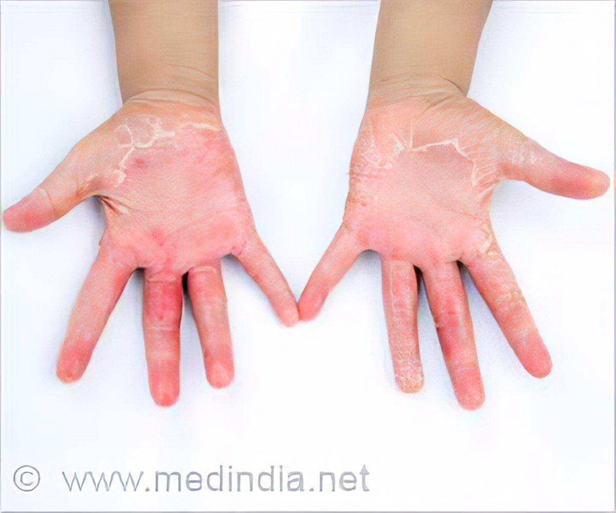 toxic-shock-syndrome-rash-on-palms