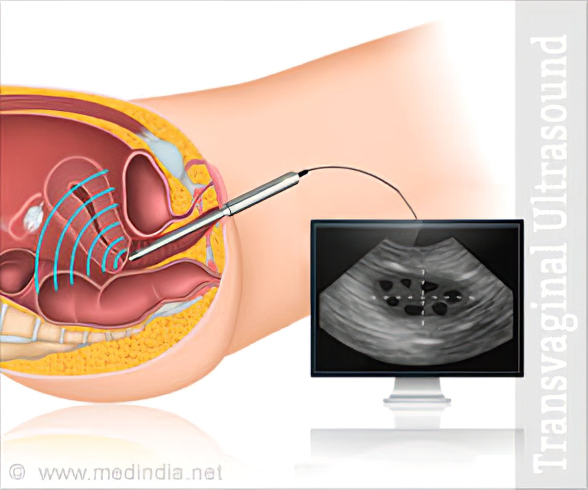 Transvaginal Ultrasound - Preparation, Procedure, Saline infusion, Contrain...