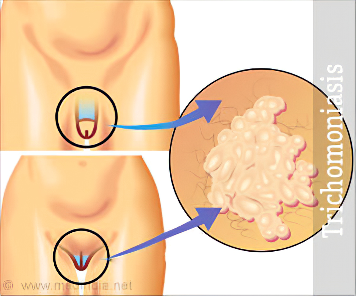 trichomoniasis men