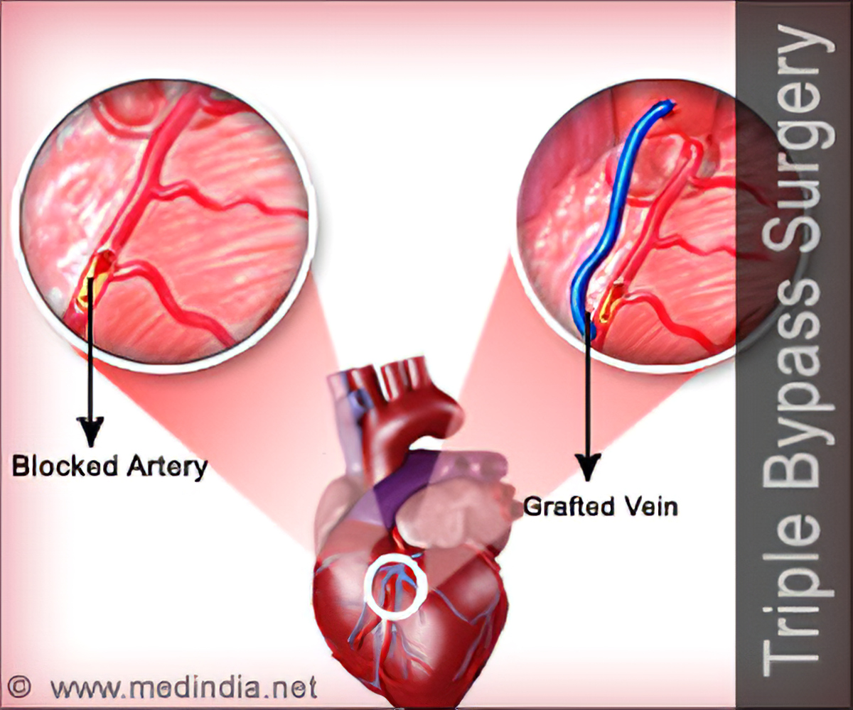 Coronary Artery Bypass Graft (CABG) Triple Bypass Surgery