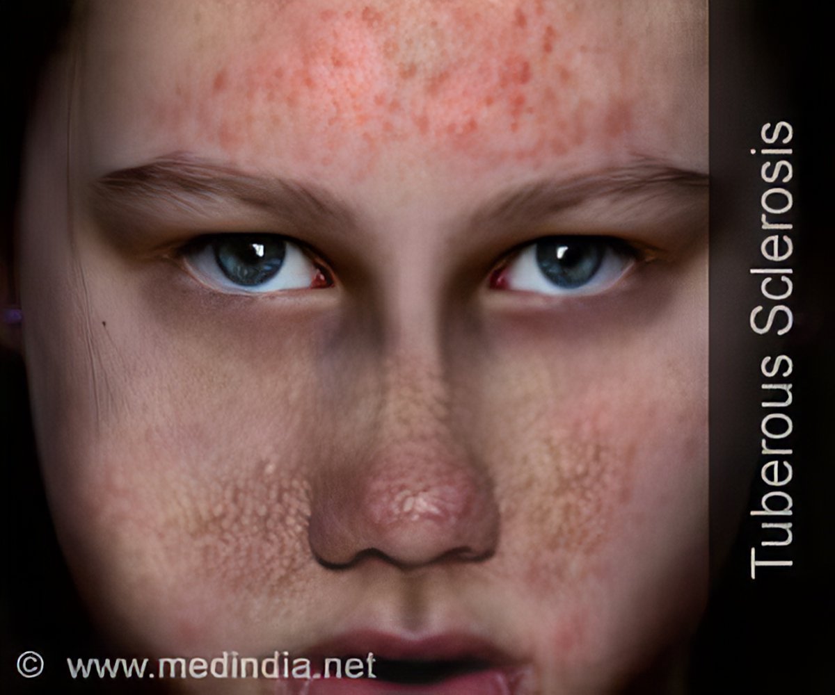 Tuberous Sclerosis Causes Symptoms Signs Diagnosis And Treatment