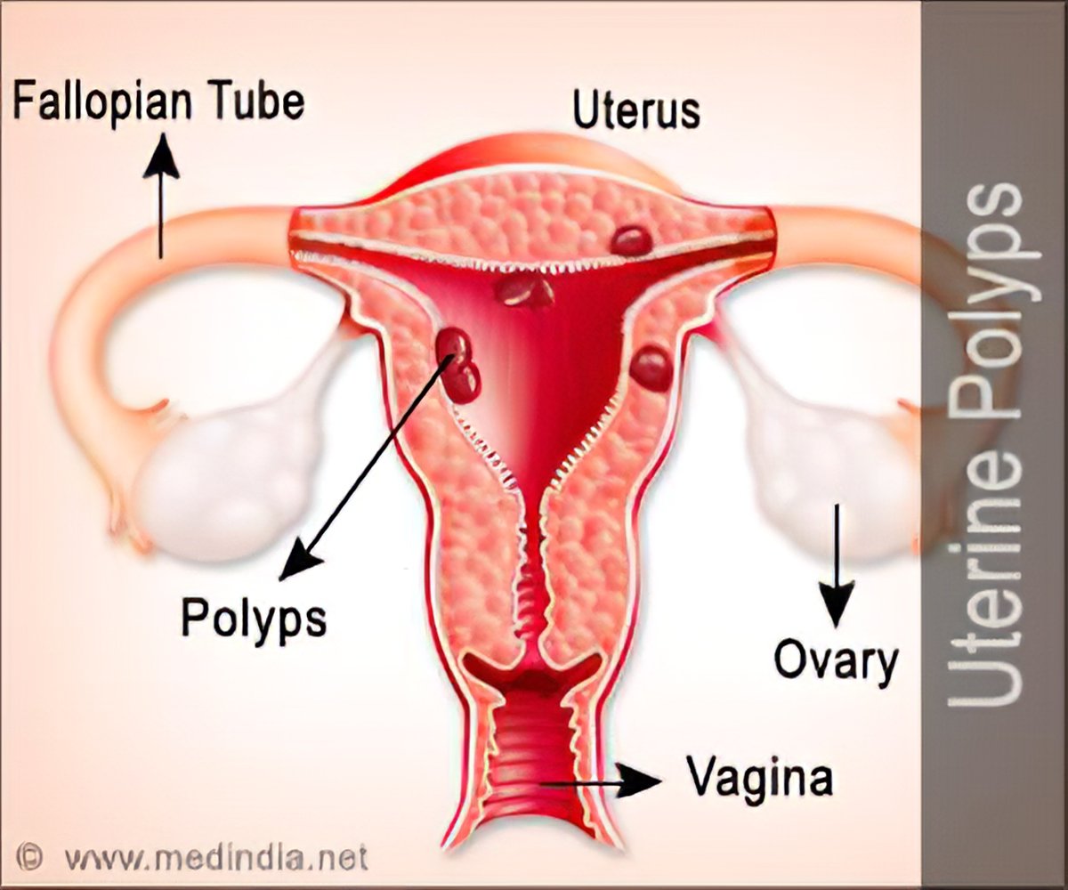 Uterine Polyps Endometrial Polyps Causes Symptoms Diagnosis Treatment