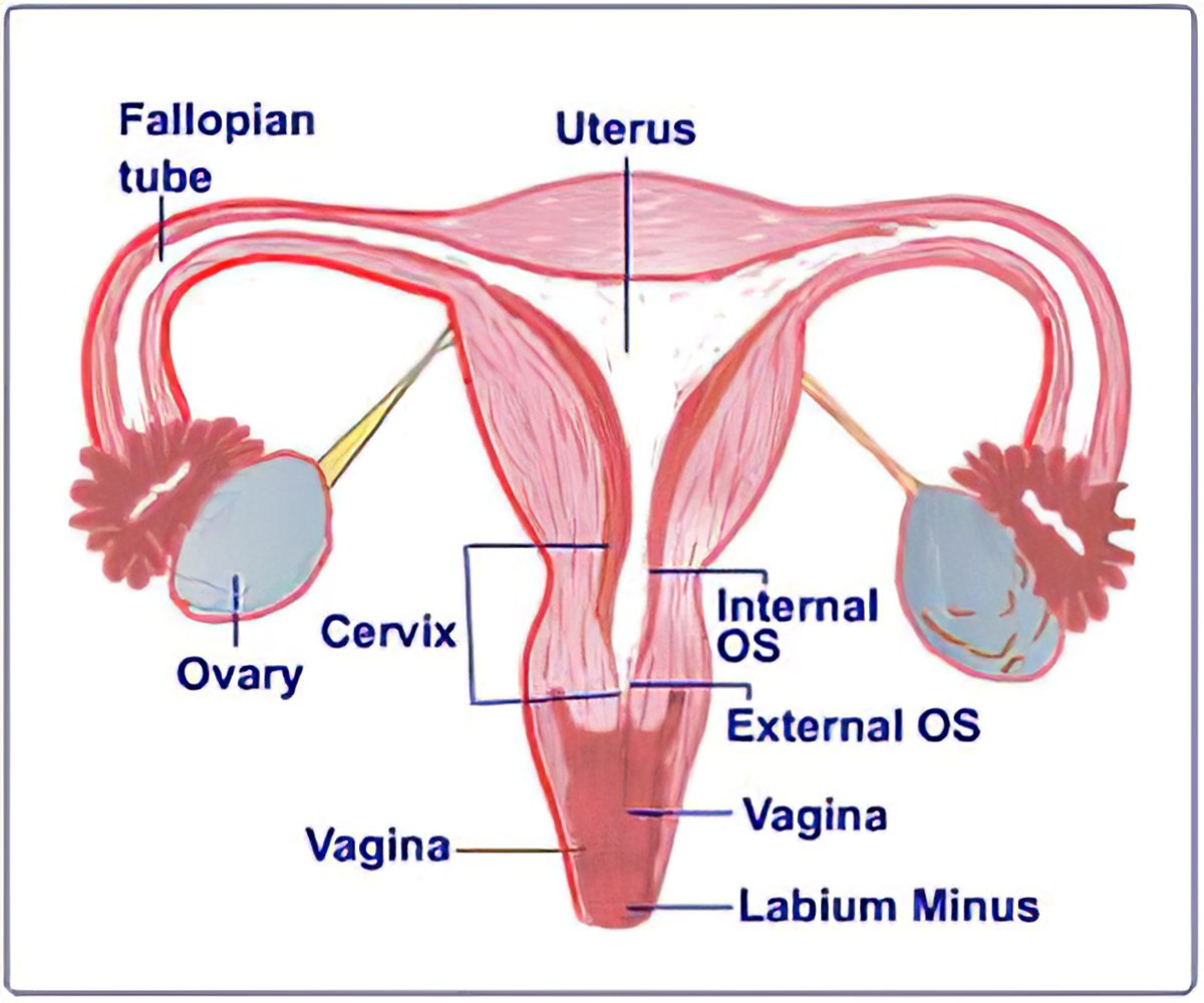 Postmenopausal bleeding (PMB) is any vaginal bleeding that occurs after a  woman has gone a year without menstrual periods. PMB is a comm