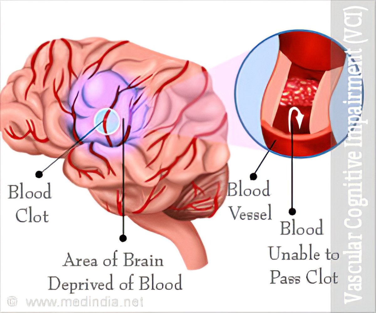 Vascular Dementia Causes Types Symptoms Diagnosis Treatment 