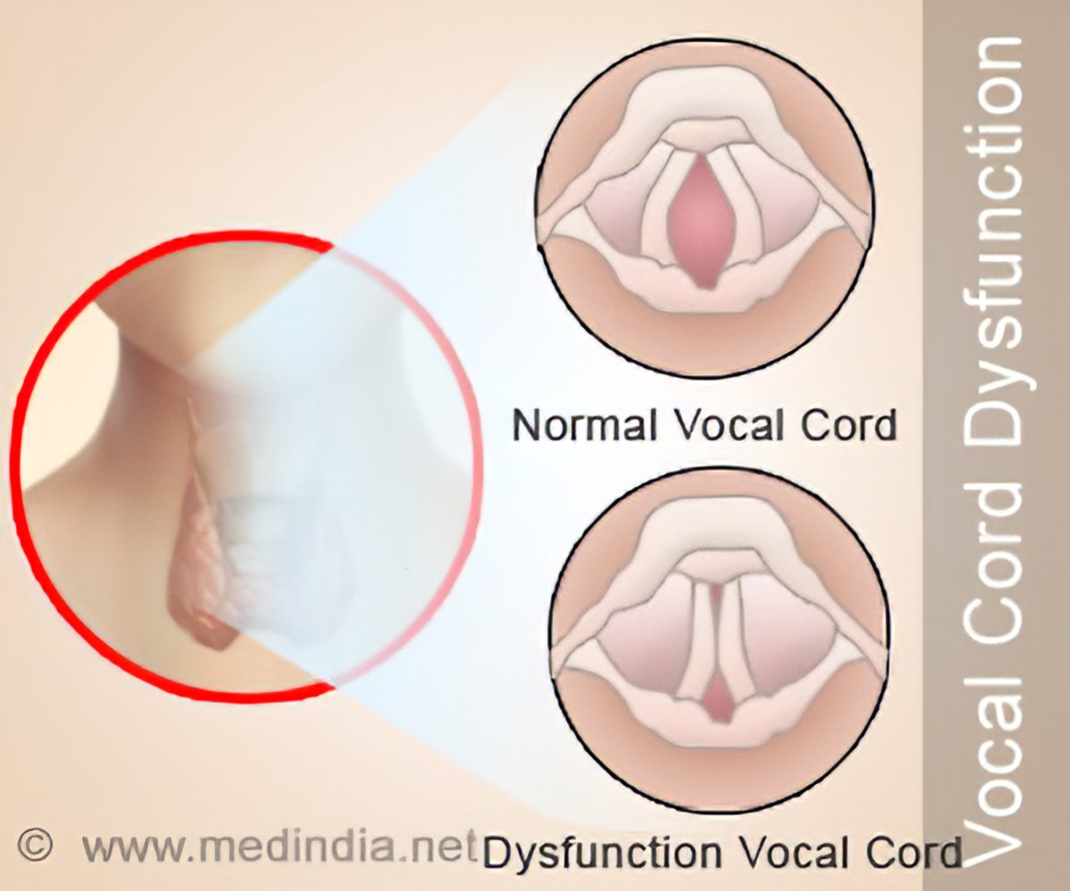 vocal-cord-dysfunction-vocal-cord-malfunction-symptoms-risk-factors