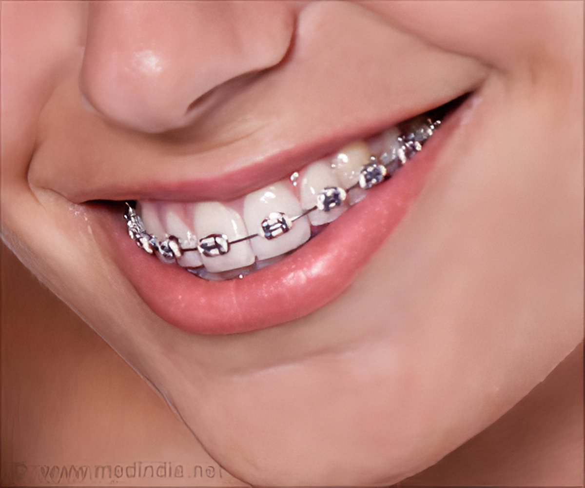 Брекеты отзывы. Металлические лигатурные брекеты Mini Diamond. Брекеты Mini Master American Orthodontics. Брекет система мини Даймонд.