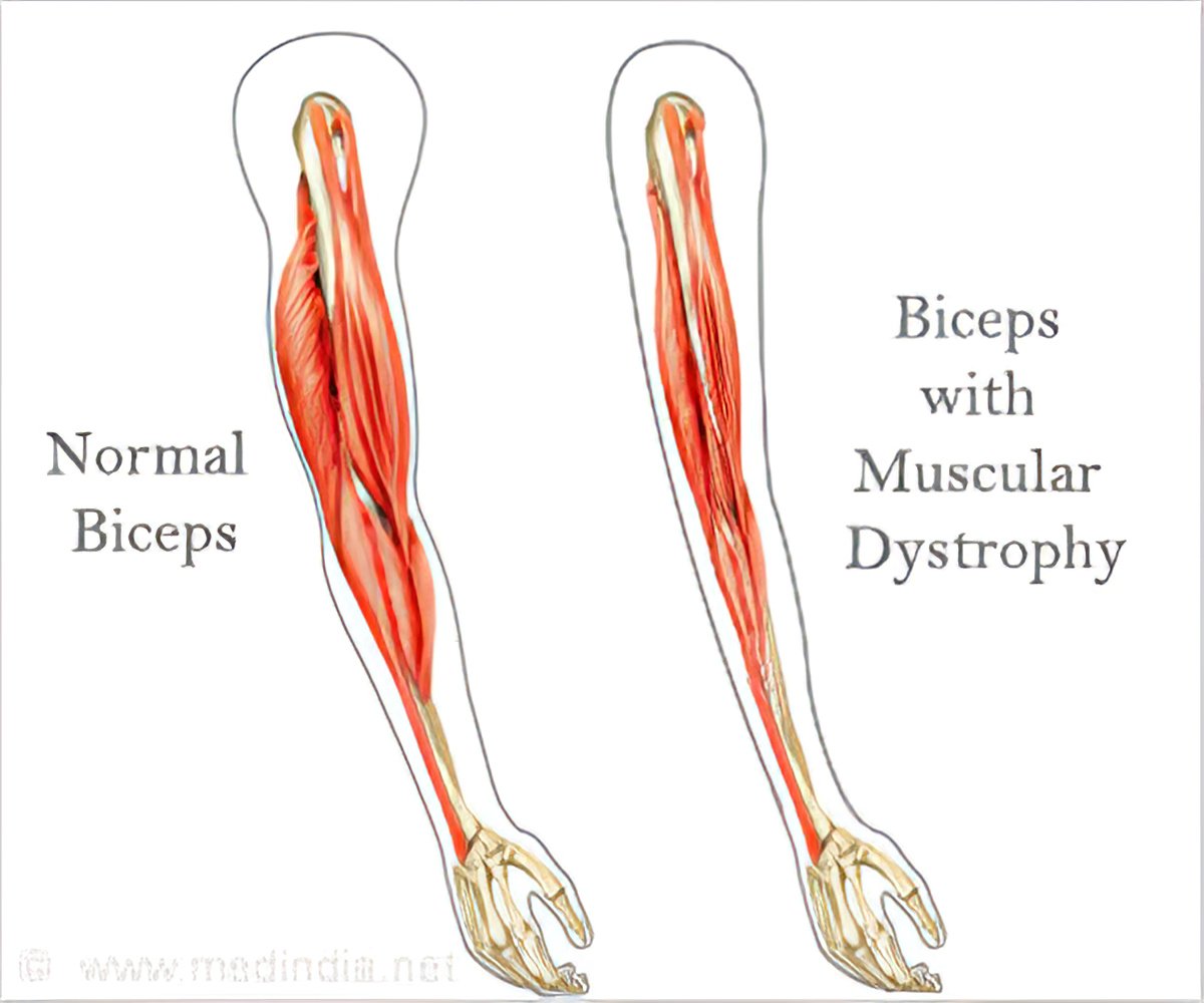 Muscular Dystrophy, Diagnosis of Muscular Dystrophy, Treatment of Muscular Dystrophy, and  3 Muscular Dystrophy Nursing Care Plan Examples.