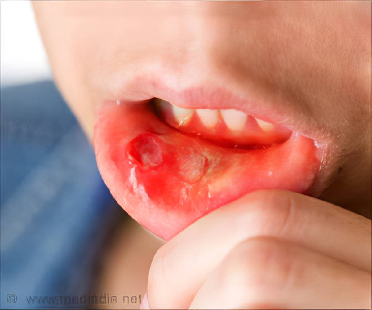 Quiz on Oral Cancer