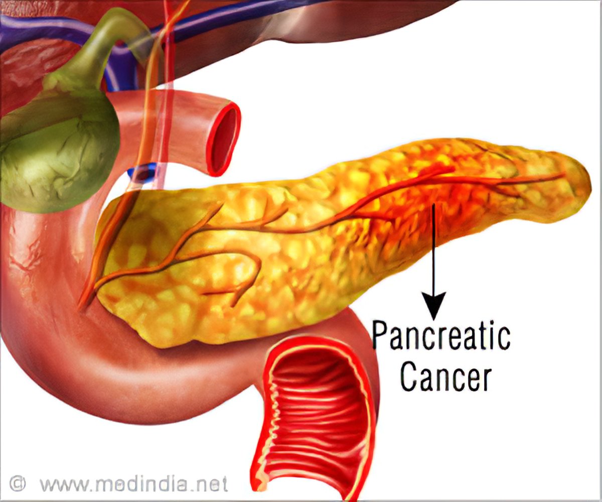 Cancer pancreatic icd Cancer pancreatic Neuroendocrine cancer of pancreas icd 10