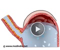Reflux Esophagitis - Animation