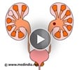 Kidney stones - Colics due to a moving Kidney stone - Animation