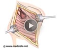 Open Ureterolithotomy - Animation