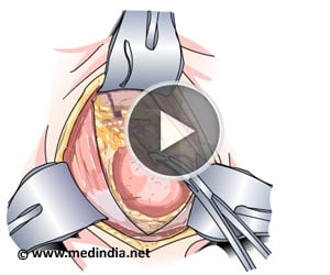 Nephrectomy