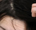 Hair Dandruff - Beauty Tips