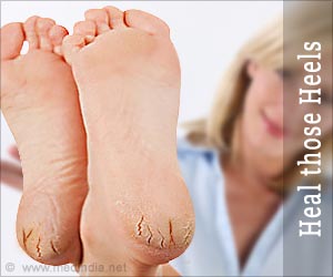 Heal those Heels: Naturally