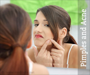 Pimples and Acne - Beauty Tips