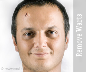 Remove Warts the Painless Way