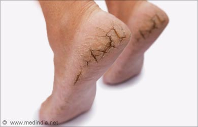 severe dry skin on feet