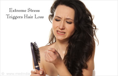 Hair Loss and Balding Hair Loss and Balding