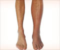 Deep Vein Thrombosis (DVT) Risk Calculator