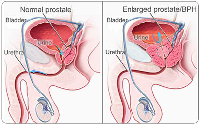 Benign Prostatic Hyperplasia