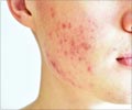 Acne - First Aid  Treatment Guide