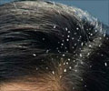 Dandruff- First Aid and Emergency Treatment Guide