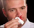 Nose Bleed (Epistaxis) - First Aid and Emergency Treatment Guide