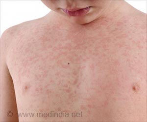 First Aid and Emergency Treatment Guide for Anaphylaxis