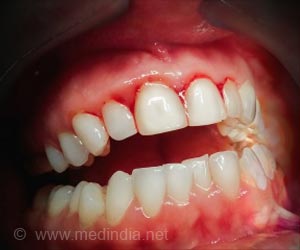 Bleeding Gums - First Aid and Emergency Treatment Guide
