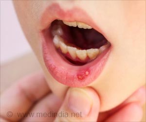 Blisters - First Aid and Emergency Treatment Guide