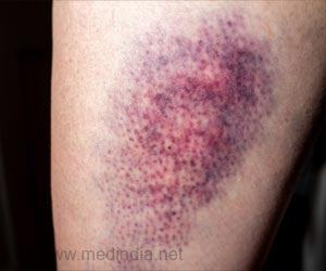 Bruises - First Aid and Emergency Treatment Guide