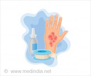 Burns - First Aid and Emergency Treatment Guide