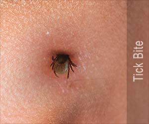 Tick Bite - First Aid and Emergency Treatment Guide