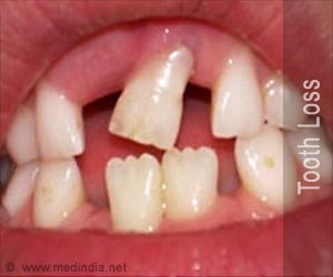 Tooth Loss - First Aid and Emergency Treatment Guide