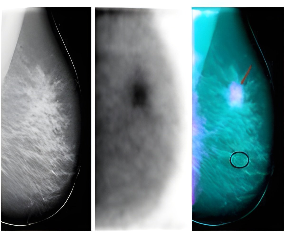 Nanoprobes and SQUID for High Tech Detection of Breast Cancer Nanoprobes and SQUID for High Tech Detection of Breast Cancer