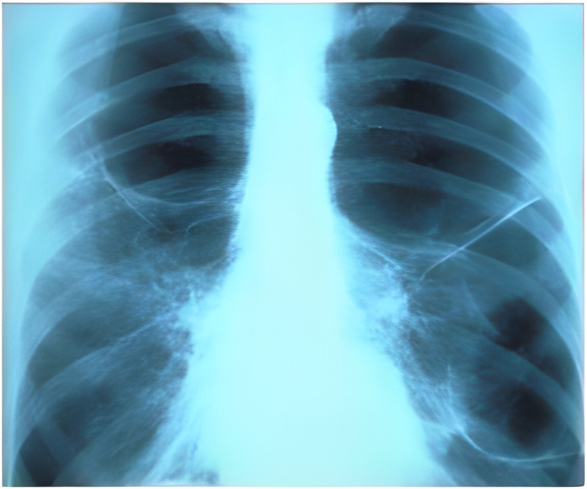 Deep Learning Improves Chest Xray Interpretation