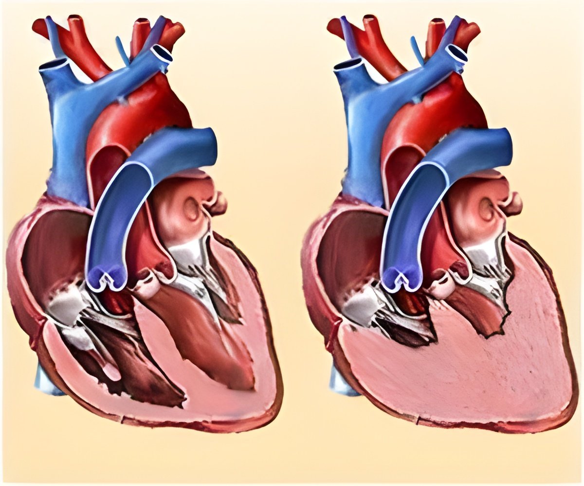 Heart failure: New electric mesh device gives the heart an