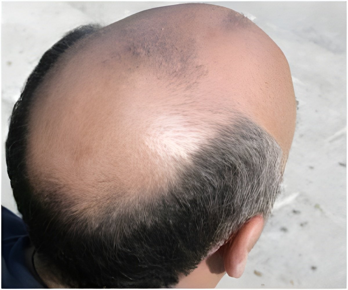 Female Hair Loss Solution