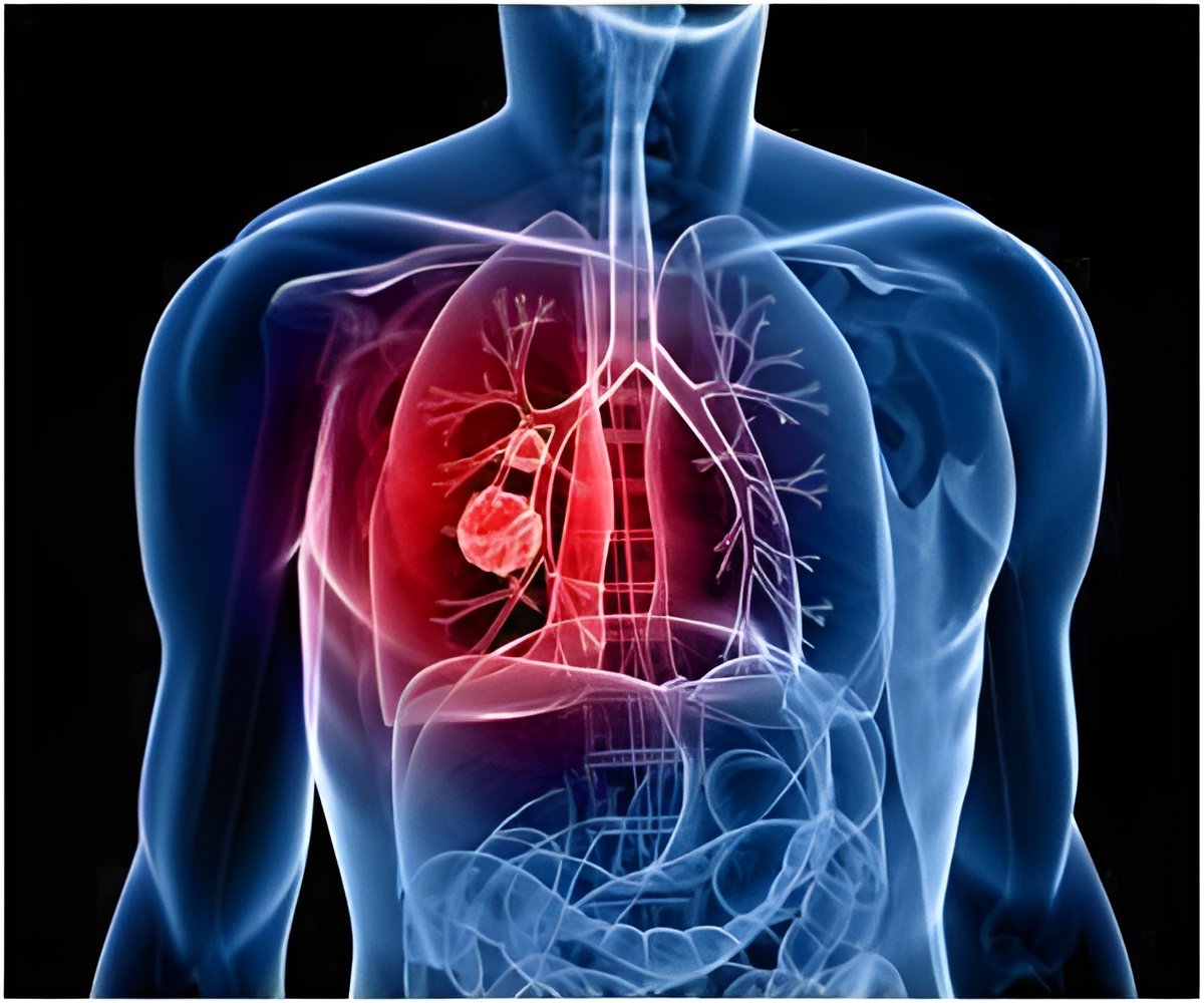 Newly Discovered Signaling Network Disrupted by Lung Cancer can be Treated Through Two Previously Approved FDA Drugs Newly Discovered Signaling Network Disrupted by Lung Cancer can be Treated Through Two Previously Approved FDA Drugs
