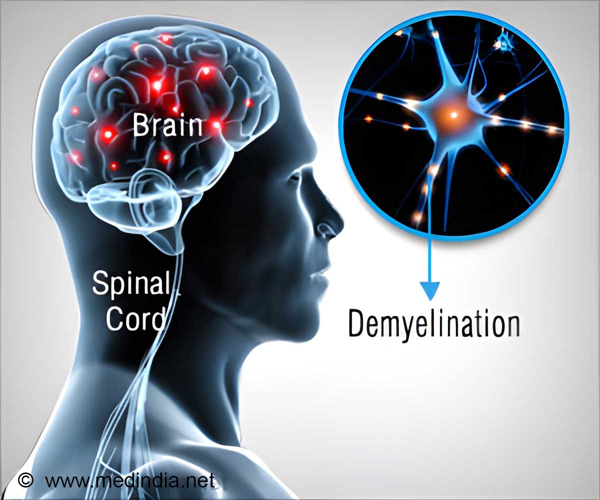 Hope for Multiple Sclerosis: A Breakthrough Drug Developed