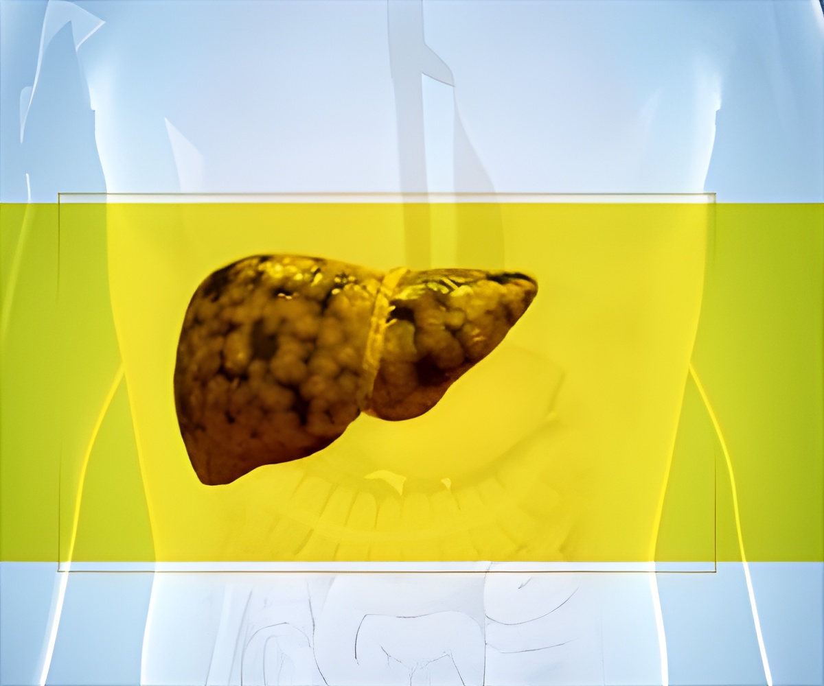 Alcohol Behind The Alcoholic Fatty Liver Disease Epidemic In India