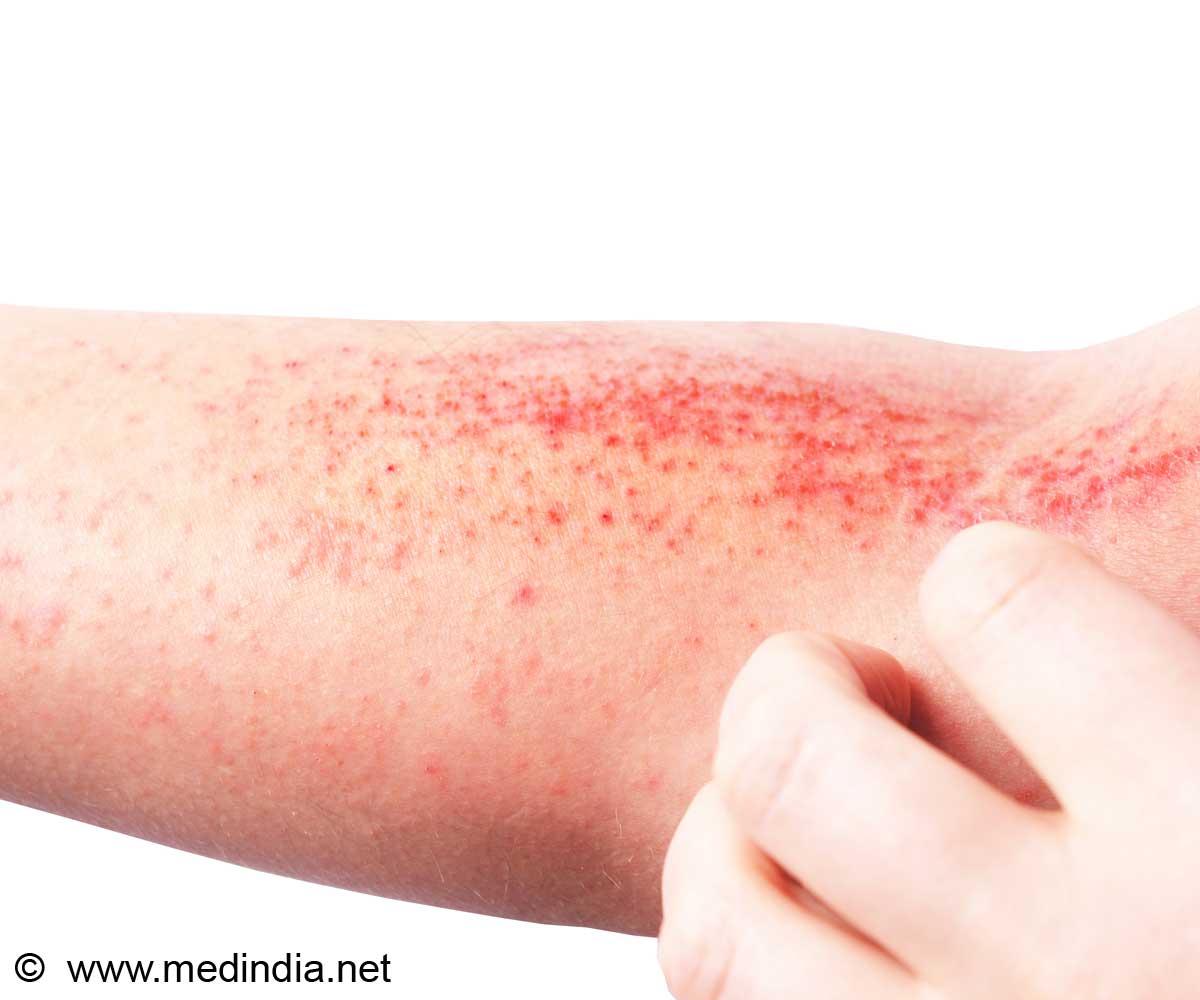 Ultrafine Bubble Showers: A Gentle Remedy for Atopic Dermatitis Ultrafine Bubble Showers: A Gentle Remedy for Atopic Dermatitis