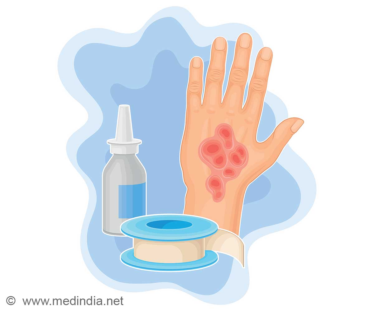 Revisiting Burn Care: Ice and Toothpaste No Longer Recommended Revisiting Burn Care: Ice and Toothpaste No Longer Recommended