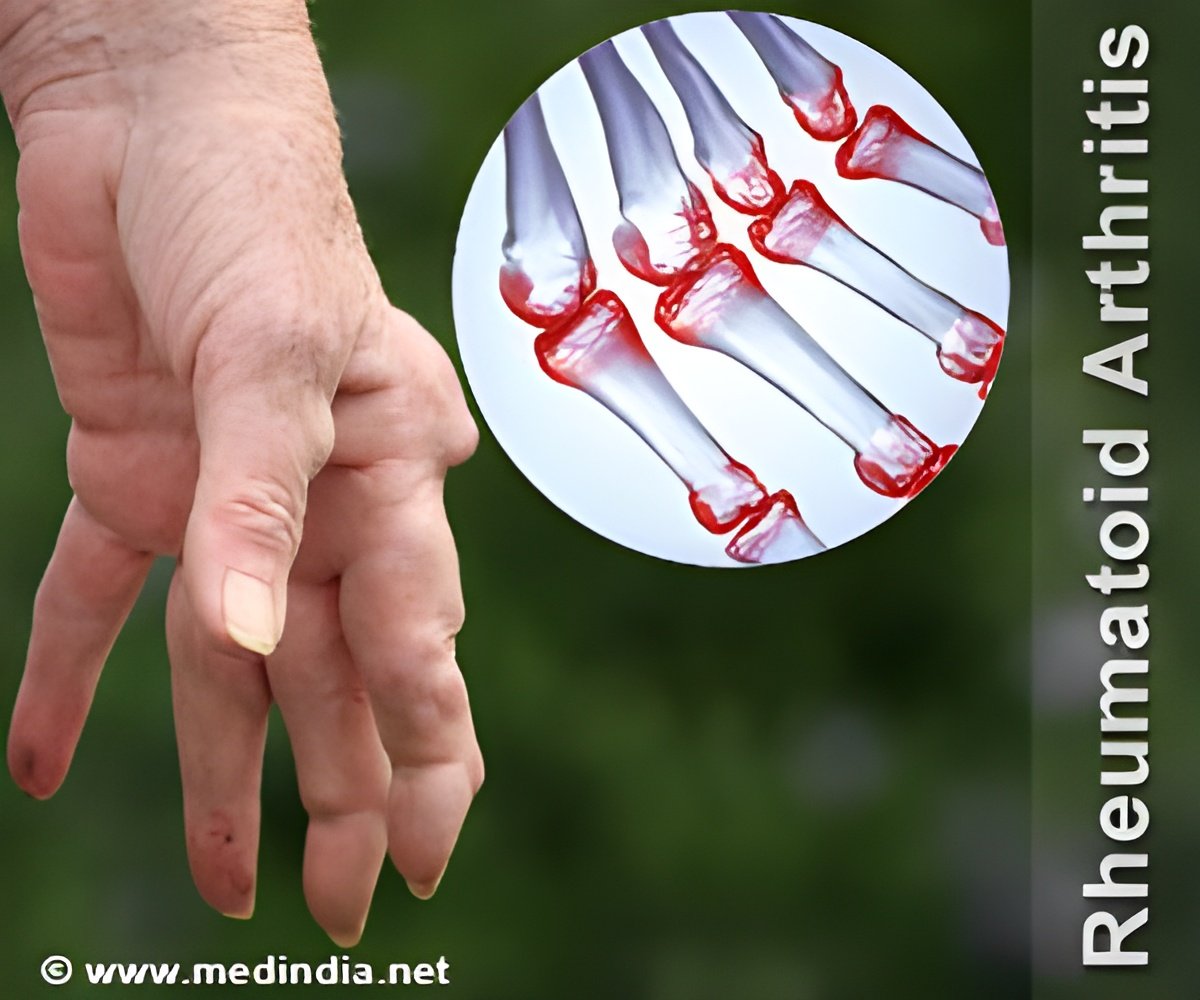 Can Ayurveda Be a Solution for Rheumatoid Arthritis?