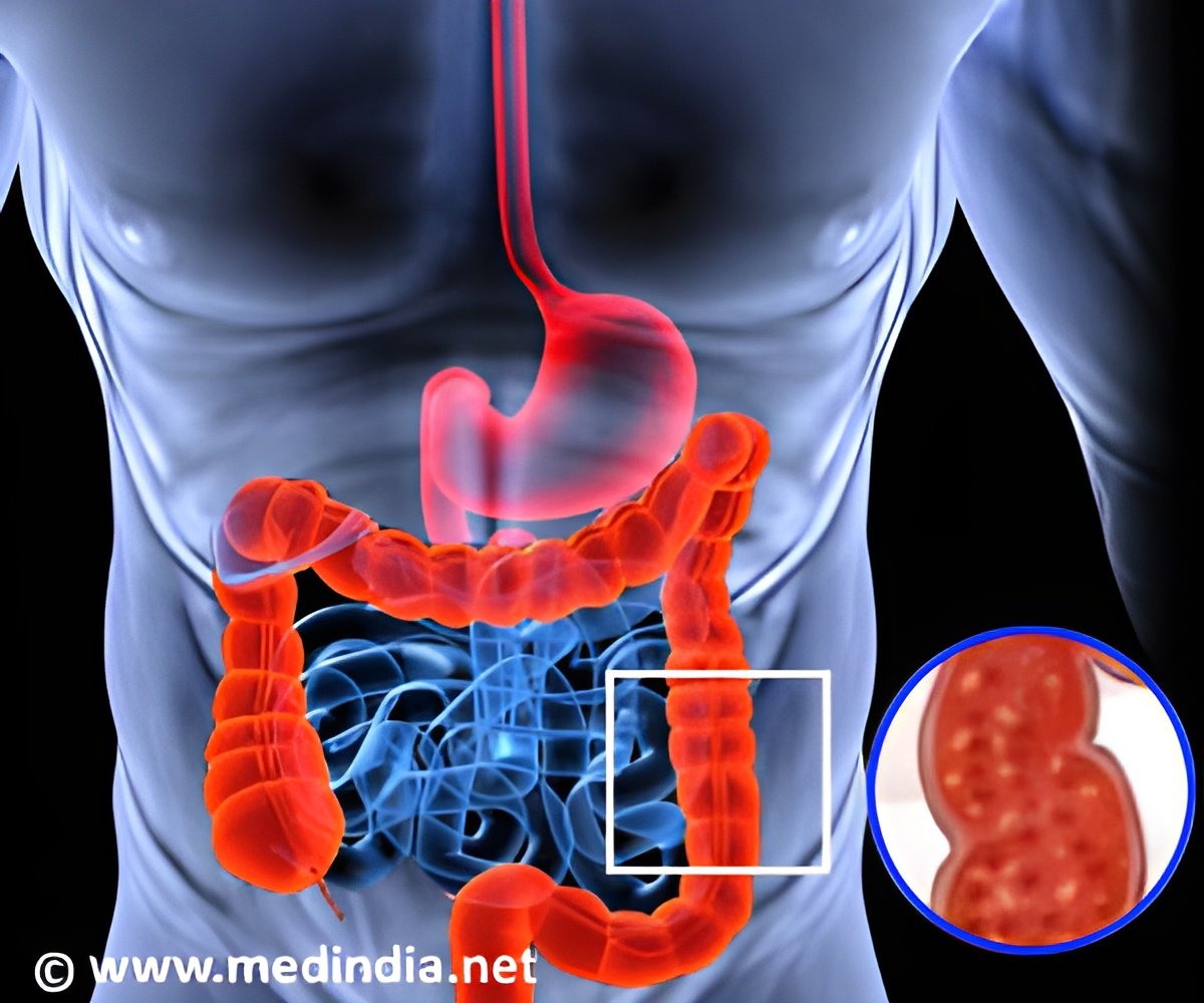 New Guideline For The Treatment Of Ulcerative Colitis