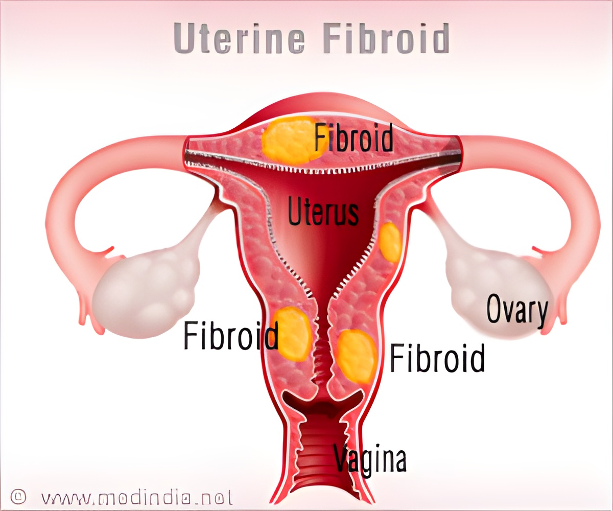 World s Largest Fibroid Weighing 9 4kg Removed At Delhi Hospital