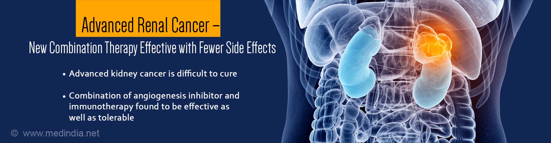 Advanced renal cancer - new combination therapy effective with fewer side effects
- advanced kidney cancer is difficult to cure
- combination of angiogenesis inhibitor and immunotherapy found to be effective as well as tolerable