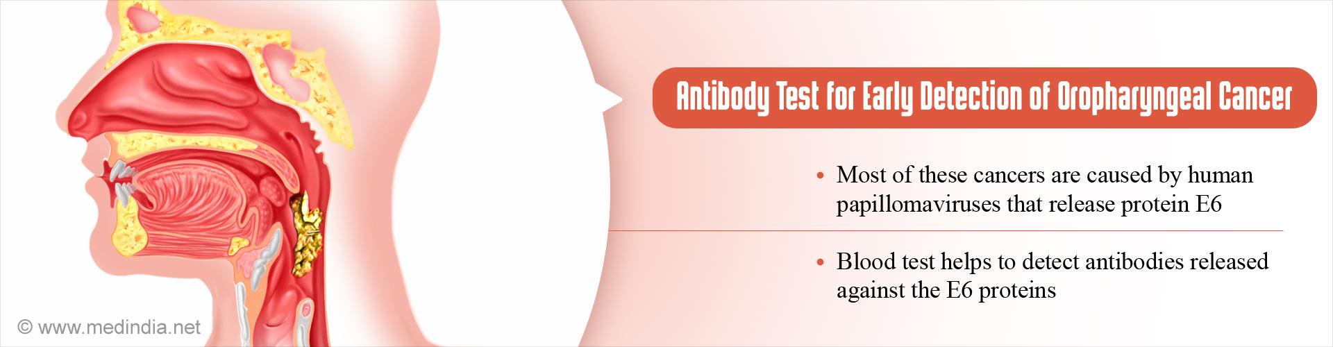 Antibody test for early detection of oropharyngeal cancer
- Most pf these cancers are caused by human pappillomaviruses that release protein E6
- Blood test helps to detect antibodies released against the E6 proteins