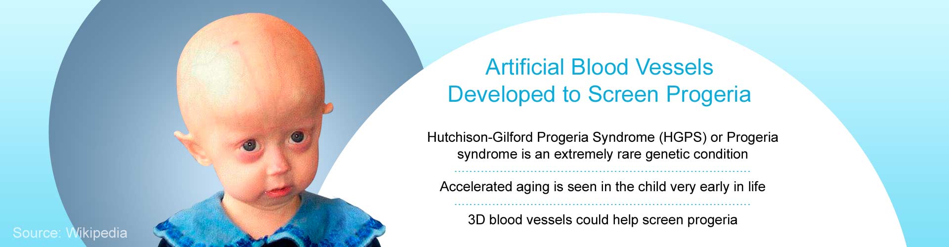 Artifical blood vessels developed to screen progeria
- Hutchison-Gilford progeria Syndrome (HGPS) or Progeria syndrome is an extremely rare genetic condition
- accelerated aging is seen in the child very early in life
- 3D blood vessels could help screen progeria